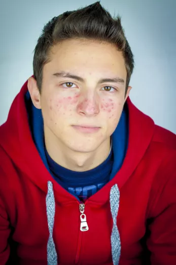 Actu GP : Acné sévère : quel rôle joue le microbiote cutané ?