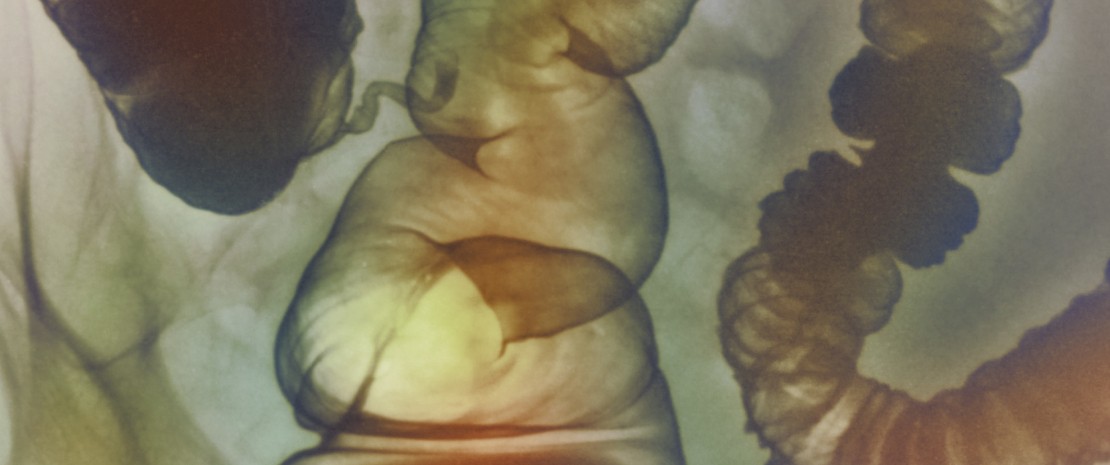  Irritable bowel syndrome (IBS). Coloured X-ray of the sigmoid colon (far right to centre) and rectum (lower centre) of a patient suffering from IBS.