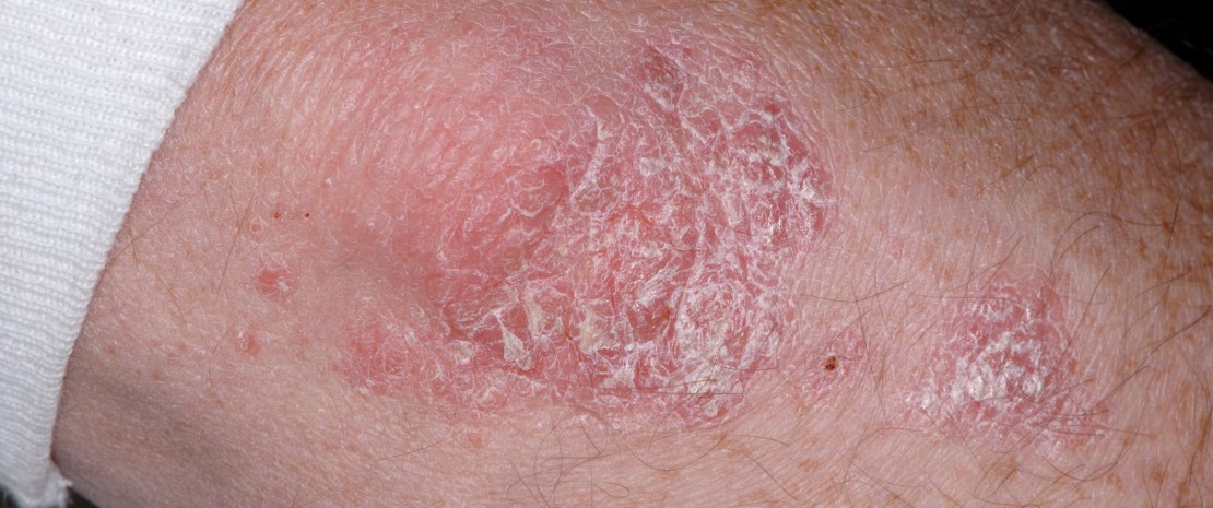 Close-up of plaque psoriasis (Psoriasis vulgaris) on an elbow.