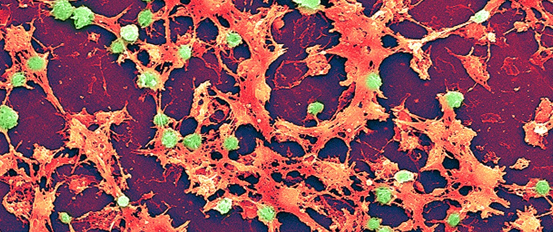Scanning Electron Micrograph (SEM) depicting large numbers of Staphylococcus aureus bacteria, which were found on the luminal surface of an indwelling catheter.