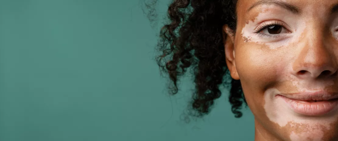 Photo: How your gut microbes drive vitiligo's white patches