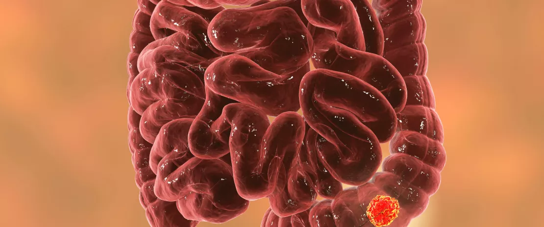 Intratumoral microbiota in colorectal cancer: an independent prognostic indicator? 