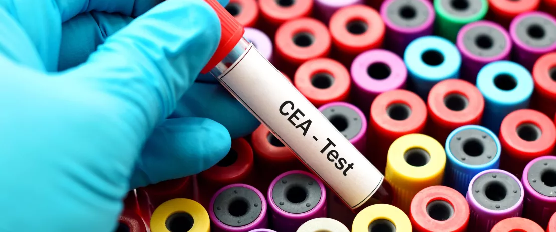 Photo : The role of Fusobacterium in colorectal cancer