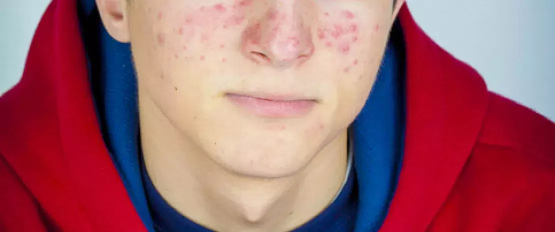 Actu GP : Acné sévère : quel rôle joue le microbiote cutané ?