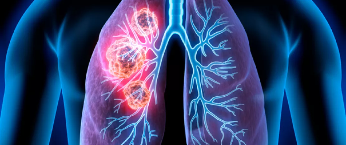 Photo : Gut microbiota could be an indicator of early-stage lung cancer