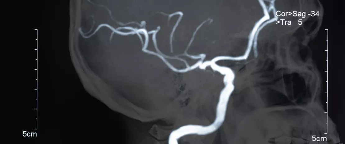 Photo : Gut dysbiosis index to assess the prognosis of stroke