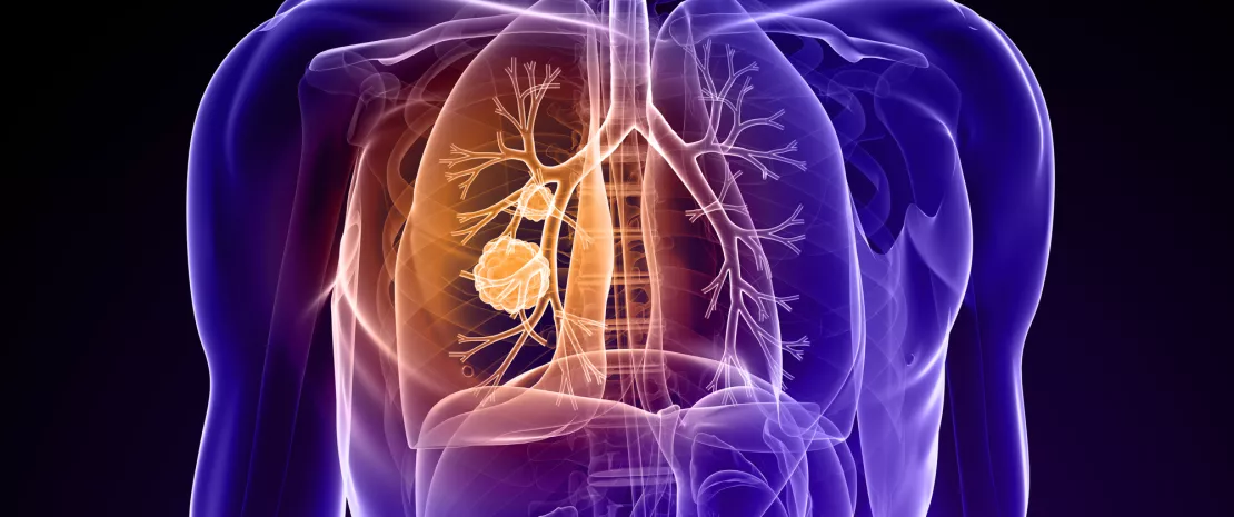 Actu PRO : Cancer du poumon : l'influence majeure du microbiote pulmonaire