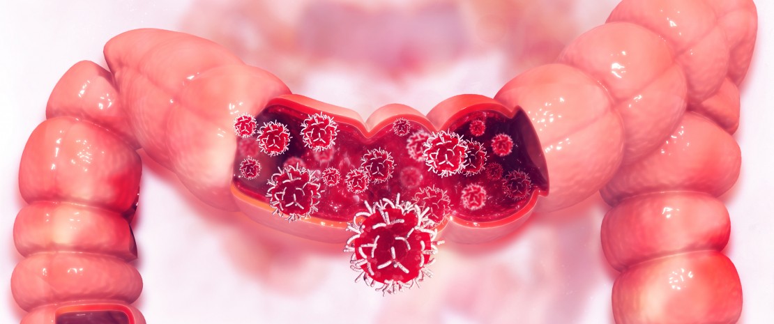Actu PRO : Cancer colorectal : un rôle pour le virome et le mycobiome ?