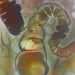  Irritable bowel syndrome (IBS). Coloured X-ray of the sigmoid colon (far right to centre) and rectum (lower centre) of a patient suffering from IBS.