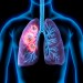 Actu PRO : Cancer du poumon : le microbiote intestinal signerait un stade précoce