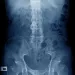 Actu PRO : Spondylarthrite ankylosante : le microbiote fongique également en cause