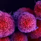 Cancer du pancréas : un diagnostic précoce non invasif grâce au microbiote fécal ?