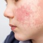 Actu PRO : Dermatite atopique : les microbiotes nasal et cutané associés à la sévérité