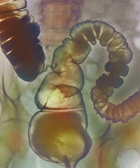  Irritable bowel syndrome (IBS). Coloured X-ray of the sigmoid colon (far right to centre) and rectum (lower centre) of a patient suffering from IBS.
