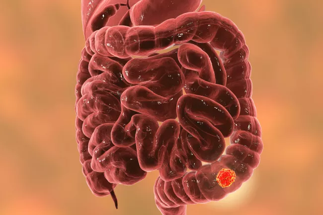 Intratumoral microbiota in colorectal cancer: an independent prognostic indicator? 