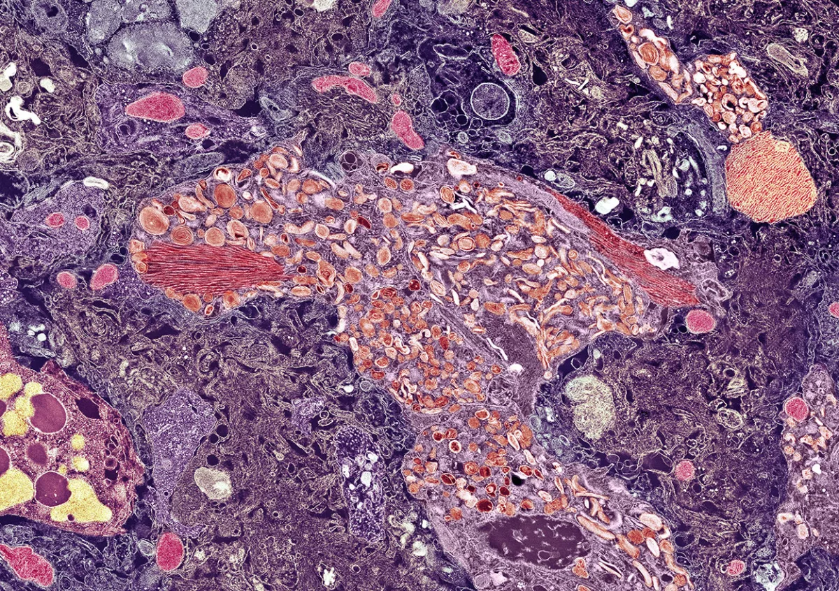 Specific microbial species correlate with amyloid and tau pathology in ...