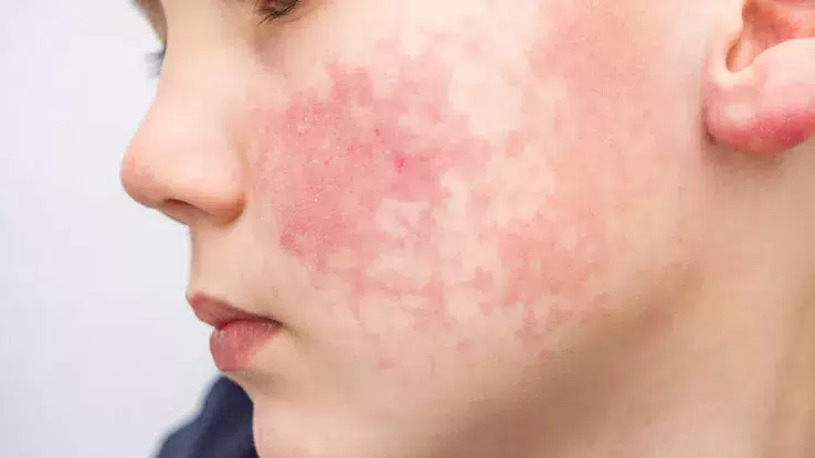 estafilococo epidermidis piel