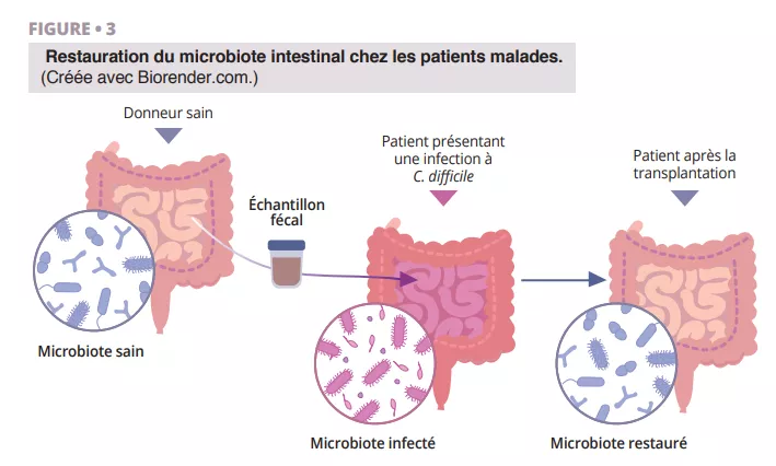 Schéma du processus de transplantation fécale pour restaurer un microbiote altéré par une infection à C. difficile.