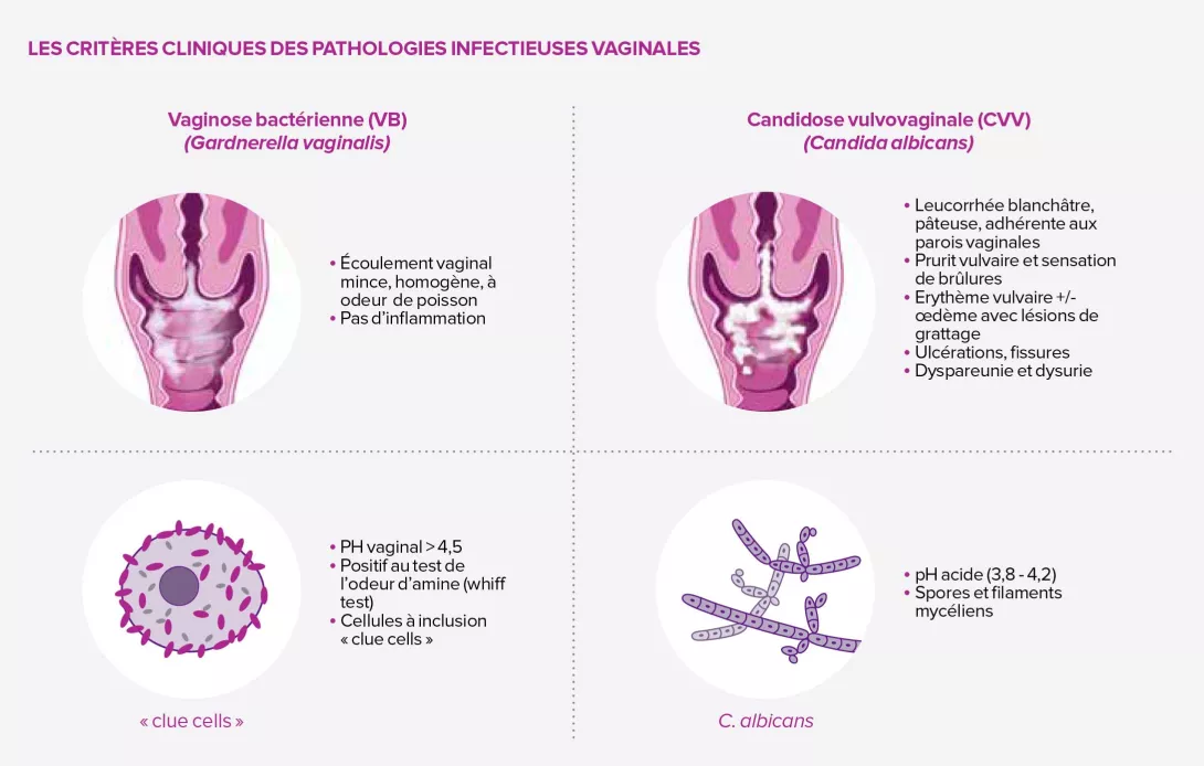 Les Pathologies Infectieuses Vaginales Contenus Pour Les Les Pathologies Infectieuses Vaginales Contenus Pour Les