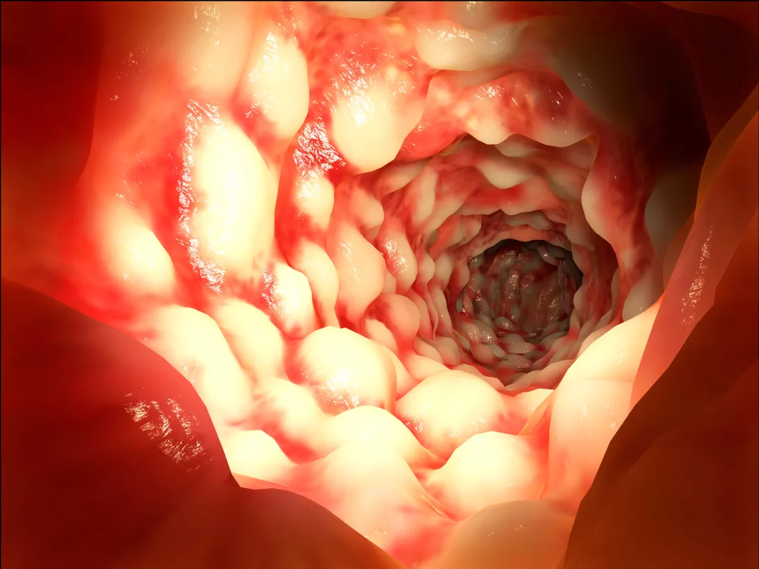 Actu PRO L’uréase bactérienne en cause dans la maladie de Crohn
